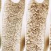 osteoporóza
